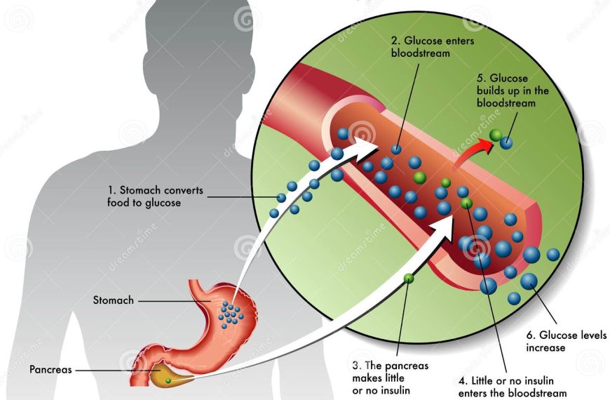 Diabetes Tipo 1: Avances Sorprendentes que Cambian Vidas